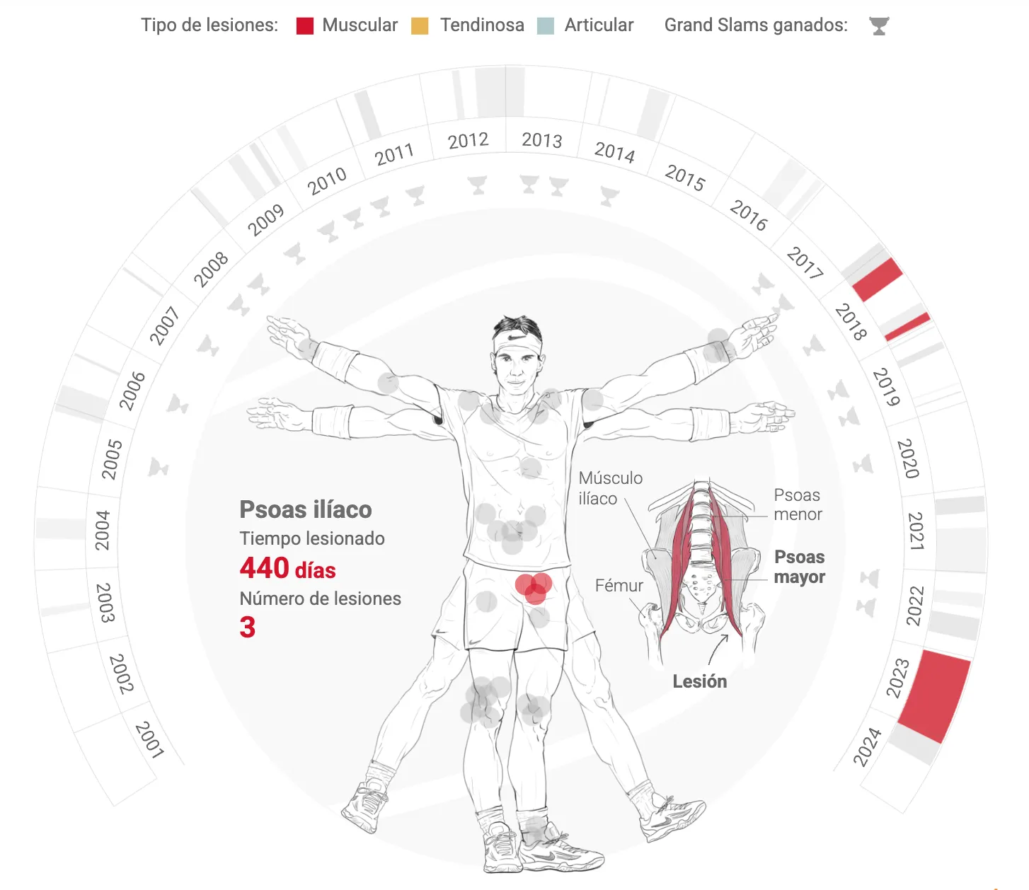 Detalle ilustrado de la tendinitis de rodilla derecha de Rafa Nadal